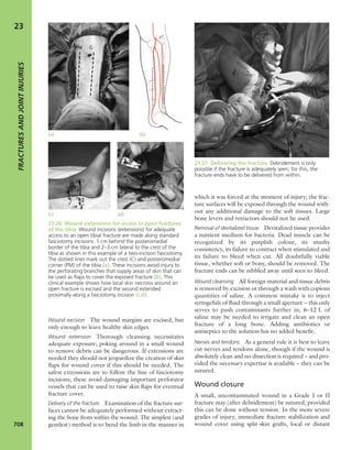 Apley's shoulderjt examination