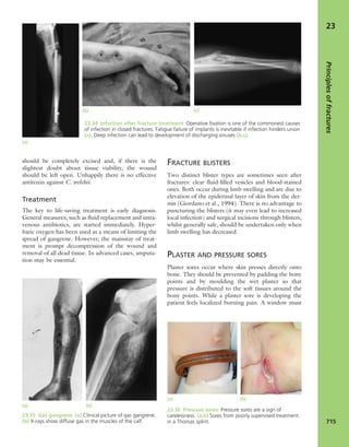 Apley's shoulderjt examination