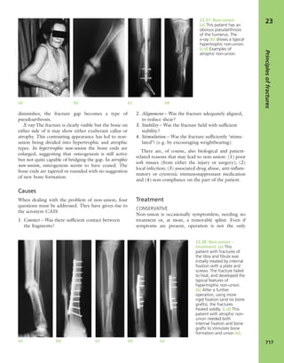 Apley's shoulderjt examination