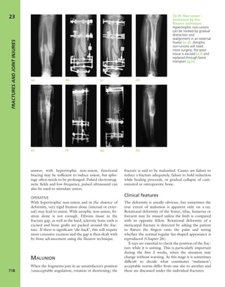 Apley's shoulderjt examination
