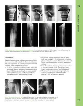Apley's shoulderjt examination
