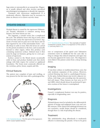 large joints or osteomyelitis in an unusual site. Diagno-
sis is usually delayed and often involves specialized
microbiological investigations to identify the organism.
Treatment with intravenous amphotericin B is
moderately effective. Operation may be necessary to
drain an abscess or to remove necrotic tissue.
HYDATID DISEASE
Hydatid disease is caused by the tapeworm Echinococ-
cus. Parasitic infestation is common among sheep
farmers, but bone lesions are rare.
The organism, a cestode worm, has a complicated
life-cycle. The deﬁnitive host is the dog or some other
carnivore that carries the tapeworm in its bowel. Seg-
ments of worm and ova pass out in the faeces and are
later ingested by one of the intermediate hosts – usu-
ally sheep or cattle or man. Here the larvae are carried
via the portal circulation to the liver, and occasionally
beyond to other organs, where they produce cysts
containing numerous scolices. Infested meat is then
eaten by dogs (or humans), giving rise to a new gen-
eration of tapeworm.
Scolices carried in the blood stream occasionally
settle in bone and produce hydatid cysts that slowly
enlarge with little respect for cortical or epiphyseal
boundaries. The bones most commonly affected are
the vertebrae, pelvis, femur, scapula and ribs.
Clinical features
The patient may complain of pain and swelling, or
may present for the ﬁrst time with a pathological frac-
ture or compression of the spinal cord. Infestation
sometimes starts in childhood but the cysts take so
long to enlarge that clinical symptoms and signs may
not become apparent for many years. The diagnosis is
more likely if the patient comes from a sheep-farming
district.
Imaging
X-rays show solitary or multiloculated bone cysts, but
only moderate expansion of the cortices. However,
cortical thinning may lead to a pathological fracture.
In the spine, hydatid disease may involve adjacent ver-
tebrae, with large cysts extending into the paraverte-
bral soft tissues. These features are best seen on CT
and MRI, which should always be performed if oper-
ative excision of the lesion is contemplated.
Investigations
Casoni’s (complement ﬁxation) test may be positive,
especially in longstanding cases.
Diagnosis
Hydatid disease must be included in the differential di-
agnosis of benign and malignant bone cysts and cyst-
like tumours. If the clinical and radiological features are
not conclusive, needle biopsy should be considered,
though there is a risk of spreading the disease.
Treatment
The anthelminthic drug albendazole is moderately
effective in destroying the parasite. It has to be given
Infection
57
2
2.16 Hydatid disease The life-cycle of the tapeworm
which causes hydatid disease.
2.17 Hydatid disease of bone Two examples of hydatid
involvement of bone: there is no expansion of the cortex in
(a) and very little in (b).
(a) (b)
 