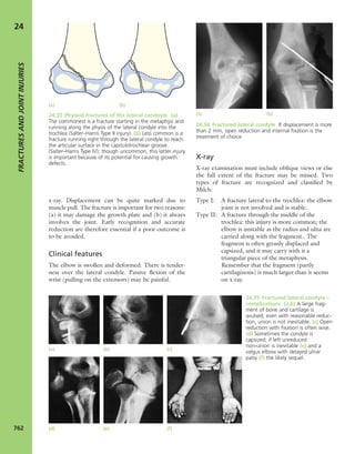 Apley's shoulderjt examination