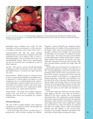 granulation tissue. Nodules occur under the skin
(especially over bony prominences), in the synovium,
on tendons, in the sclera and in many of the viscera.
Lymphadenopathy Not only the nodes draining
inﬂamed joints, but also those at a distance such as the
mediastinal nodes, can be affected. This, as well as a
mild splenomegaly, is due to hyperactivity of the reti-
culoendothelial system. More severe splenomegaly
can also be associated with neutropaenia as part of
Felty’s syndrome.
Vasculitis This can be a serious and life-threatening
complication of RA. Involvement of the skin, includ-
ing nailfold infarcts, is common but organ infarction
can occur.
Muscle weakness Muscle weakness is common. It may
be due to a generalized myopathy or neuropathy, but it
is important to exclude spinal cord disease or cord
compression due to vertebral displacement (atlanto-
axial subluxation). Sensory changes may be part of a
neuropathy, but localized sensory and motor symp-
toms can also result from nerve compression by thick-
ened synovium (e.g. carpal tunnel syndrome).
Visceral disease The lungs, heart, kidneys, gastroin-
testinal tract and brain are sometimes affected.
Ischaemic heart disease and osteoporosis are common
complications.
Clinical features
The onset of RA is usually insidious, with symptoms
emerging over a period of months. Occasionally the
disease starts quite suddenly.
In the early stages the picture is mainly that of a
polysynovitis, with soft-tissue swelling and stiffness.
Typically, a woman of 30–40 years complains of pain,
swelling and loss of mobility in the proximal joints of
the ﬁngers. There may be a previous history of ‘mus-
cle pain’, tiredness, loss of weight and a general lack
of well-being. As time passes, the symptoms ‘spread’
to other joints – the wrists, feet, knees and shoulders
in order of frequency. Another classic feature is gener-
alized stiffness after periods of inactivity, and espe-
cially after rising from bed in the early morning. This
early morning stiffness typically lasts longer than 30
minutes.
Physical signs may be minimal, but usually there is
symmetrically distributed swelling and tenderness of
the metacarpophalangeal joints, the proximal inter-
phalangeal joints and the wrists. Tenosynovitis is com-
mon in the extensor compartments of the wrist and
the ﬂexor sheaths of the ﬁngers; it is diagnosed by
feeling thickening, tenderness and crepitation over
the back of the wrist or the palm while passively mov-
ing the ﬁngers. If the larger joints are involved, local
warmth, synovial hypertrophy and intra-articular effu-
sion may be more obvious. Movements are often lim-
ited but the joints are still stable and deformity is
unusual.
In the later stages joint deformity becomes increas-
ingly apparent and the acute pain of synovitis is
replaced by the more constant ache of progressive
joint destruction. The combination of joint instability
and tendon rupture produces the typical ‘rheumatoid’
deformities: ulnar deviation of the ﬁngers, radial and
volar displacement of the wrists, valgus knees, valgus
feet and clawed toes. Joint movements are restricted
and often very painful. About a third of all patients
develop pain and stiffness in the cervical spine.
Function is increasingly disturbed and patients may
need help with grooming, dressing and eating.
Inflammatoryrheumaticdisorders
61
3
(a) (b)
3.2 Rheumatoid synovitis (a) The macroscopic appearance of rheumatoid synovitis with ﬁbrinoid material oozing
through a rent in the capsule. (b) Histology shows proliferating synovium with round-cell inﬁltration and ﬁbrinoid particles
in the joint cavity (x120).
 