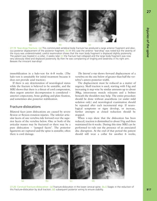 Apley's shoulderjt examination