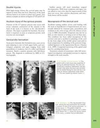 Apley's shoulderjt examination