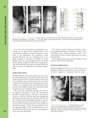 Apley's shoulderjt examination