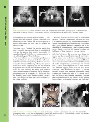 Apley's shoulderjt examination