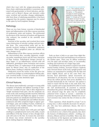 which then react with the antigen-presenting cells.
Since classic ankylosing spondylitis is sometimes asso-
ciated with genitourinary or bowel infection, and dis-
orders such as Reiter’s disease and ulcerative colitis
cause vertebral and sacroiliac changes indistinguish-
able from those of ankylosing spondylitis, it has been
suggested that the putative organism may be carried
to the spine by local lymphatic drainage.
Pathology
There are two basic lesions: synovitis of diarthrodial
joints and inﬂammation at the ﬁbro-osseous junctions
of syndesmotic joints and tendons. The preferential
involvement of the insertion of tendons and ligaments
(the entheses) has resulted in the unwieldy term
enthesopathy.
Synovitis of the sacroiliac and vertebral facet joints
causes destruction of articular cartilage and peri-artic-
ular bone. The costovertebral joints also are fre-
quently involved, leading to diminished respiratory
excursion. When peripheral joints are affected the
same changes occur.
Inﬂammation of the ﬁbro-osseous junctions affects
the intervertebral discs, sacroiliac ligaments, symph-
ysis pubis, manubrium sterni and the bony insertions
of large tendons. Pathological changes proceed in
three stages: (1) an inﬂammatory reaction with cell
inﬁltration, granulation tissue formation and erosion
of adjacent bone; (2) replacement of the granulation
tissue by ﬁbrous tissue; and (3) ossiﬁcation of the
ﬁbrous tissue, leading to ankylosis of the joint.
Ossiﬁcation across the surface of the disc gives rise
to small bony bridges or syndesmophytes linking adja-
cent vertebral bodies. If many vertebrae are involved
the spine may become absolutely rigid.
Clinical features
The disease starts insidiously: a teenager or young adult
complains of backache and stiffness recurring at inter-
vals over a number of years. This is often diagnosed as
‘simple mechanical back pain’, but the symptoms are
worse in the early morning and after inactivity. Referred
pain in the buttocks and thighs may appear as ‘sciatica’
and some patients are mistakenly treated for interverte-
bral disc prolapse. Gradually pain and stiffness become
continuous and other symptoms begin to appear: gen-
eral fatigue, pain and swelling of joints, tenderness at
the insertion of the Achilles tendon, ‘foot strain’, or
intercostal pain and tenderness.
Occasionally the disease starts with pain and slight
swelling in a peripheral joint such as the ankle, or pain
and stiffness of the hip. Sooner or later, though, back-
ache will come to the fore. In women the axial skele-
tal disease may remain restricted to the sacroiliac
joints making diagnosis challenging.
Early on there is little to see apart from slight ﬂat-
tening of the lower back and limitation of extension in
the lumbar spine. There may be diffuse tenderness
over the spine and sacroiliac joints, or (occasionally)
swelling and tenderness of a single large joint.
In established cases the posture is typical: loss of the
normal lumbar lordosis, increased thoracic kyphosis
and a forward thrust of the neck; upright posture and
balance are maintained by standing with the hips and
knees slightly ﬂexed, and in late cases these may
become ﬁxed deformities. Spinal movements are
diminished in all directions, but loss of extension is
always the earliest and the most severe disability. It is
revealed dramatically by the ‘wall test’: the patient is
asked to stand with his back to the wall; heels, but-
tocks, scapulae and occiput should all be able to touch
the wall simultaneously. If extension is seriously
diminished the patient will ﬁnd this impossible. In the
most advanced stage the spine may be completely
ankylosed from occiput to sacrum – sometimes in
positions of grotesque deformity. Marked loss of cer-
vical extension may restrict the line of vision to a few
paces.
Chest expansion, which should be at least 7 cm in
young men, is often markedly decreased. In old peo-
ple, who may have pulmonary disease, this test is
unreliable.
Peripheral joints (usually shoulders, hips and knees)
are involved in over a third of the patients; they show
the features of inﬂammatory arthritis – swelling, ten-
derness, effusion and loss of mobility. There may also
be tenderness of the ligament and tendon insertions
close to a large joint or under the heel.
Inflammatoryrheumaticdisorders
67
3
(a) (b)
3.7 Ankylosing spondylitis
– early The cardinal clinical
feature is marked stiffness of
the spine. (a) This patient
manages to stand upright by
keeping his knees slightly
ﬂexed. (b) It looks as if he can
bend down to touch his toes,
but his back is rigid and all the
movement takes place at his
hips.
 