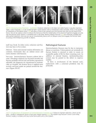 Apley's shoulderjt examination
