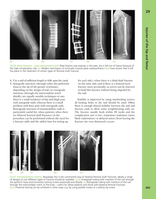 Apley's shoulderjt examination