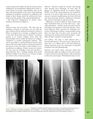 Apley's shoulderjt examination
