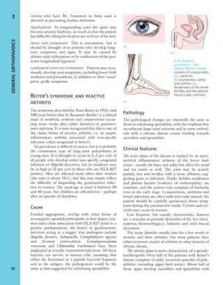 victims who have AS. Treatment in these cases is
directed at preventing further deformity.
Hyperkyphosis In longstanding cases the spine may
become severely kyphotic, so much so that the patient
has difﬁculty lifting his head to see in front of his feet.
Spinal cord compression This is uncommon, but it
should be thought of in patients who develop long-
tract symptoms and signs. It may be caused by
atlanto-axial subluxation or by ossiﬁcation of the pos-
terior longitudinal ligament.
Lumbosacral nerve root compression Patients may occa-
sionally develop root symptoms, including lower limb
weakness and paraesthesia, in addition to their ‘usual’
pelvic girdle symptoms.
REITER’S SYNDROME AND REACTIVE
ARTHRITIS
The syndrome described by Hans Reiter in 1916 (and
100 years before that by Benjamin Brodie) is a clinical
triad of urethritis, arthritis and conjunctivitis occur-
ring some weeks after either dysentery or genitouri-
nary infection. It is now recognized that this is one of
the classic forms of reactive arthritis, i.e. an aseptic
inﬂammatory arthritis associated with non-speciﬁc
infection (often urogenital or bowel).
Its prevalence is difﬁcult to assess, but it is probably
the commonest type of large-joint polyarthritis in
young men. It is thought to occur in 1–3 per cent of
all people who develop either non-speciﬁc urogenital
infection or Shigella dysentery, but its incidence may
be as high as 25 per cent in those who are HLA-B27
positive. Men are affected more often than women
(the ratio is about 10:1), but this may simply reﬂect
the difﬁculty of diagnosing the genitourinary infec-
tion in women. The usual age at onset is between 20
and 40 years, but children are affected too – perhaps
after an episode of diarrhoea.
Cause
Familial aggregation, overlap with other forms of
seronegative spondyloarthropathy in ﬁrst-degree rela-
tives and a close association with HLA-B27 point to a
genetic predisposition, the bowel or genitourinary
infection acting as a trigger. Gut pathogens include
Shigella ﬂexneri, Salmonella, Campylobacter species
and Yersinia enterocolitica. Lymphogranuloma
venereum and Chlamydia trachomatis have been
implicated as sexually transmitted infections. All these
bacteria can survive in human cells; assuming that
either the bacterium or a peptide bacterial fragment
acts as the antigen, the pathogenesis could be the
same as that suggested for ankylosing spondylitis.
Pathology
The pathological changes are essentially the same as
those in ankylosing spondylitis, with the emphasis ﬁrst
on subacute large-joint synovitis and in some individ-
uals with a chronic disease course tending towards
sacroiliitis and spondylitis.
Clinical features
The acute phase of the disease is marked by an asym-
metrical inﬂammatory arthritis of the lower limb
joints – usually the knee and ankle but often the tarsal
and toe joints as well. The joint may be acutely
painful, hot and swollen with a tense effusion, sug-
gesting gout or infection. Tendo Achilles tenderness
and plantar fasciitis (evidence of enthesopathy) are
common, and the patient may complain of backache
even in the early stage. Conjunctivitis, urethritis and
bowel infections are often mild and easily missed; the
patient should be carefully questioned about symp-
toms during the previous few weeks. Cystitis and cer-
vicitis may occur in women.
Less frequent, but equally characteristic, features
are a vesicular or pustular dermatitis of the feet (kera-
toderma blennorrhagica), balanitis and mild buccal
ulceration.
The acute disorder usually lasts for a few weeks or
months and then subsides, but most patients have
either recurrent attacks of arthritis or other features of
chronic disease.
The chronic phase is more characteristic of a spondy-
loarthropathy. Over half of the patients with Reiter’s
disease complain of mild, recurrent episodes of poly-
arthritis (including upper limb joints). About half of
those again develop sacroiliitis and spondylitis with
GENERALORTHOPAEDICS
70
3
(a)
(b)
(c)
3.10 Reiter’s
syndrome – the
classic ‘Reiter’s triad’
consists of conjunctivitis
(a), urethritis
(b) (sometimes colitis)
and arthritis (c).
Tenderness of the tendo
Achilles and the plantar
fascia is also common.
 