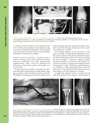 Apley's shoulderjt examination