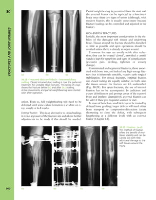Apley's shoulderjt examination