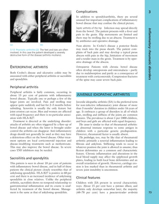 ENTEROPATHIC ARTHRITIS
Both Crohn’s disease and ulcerative colitis may be
associated with either peripheral arthritis or sacroiliitis
and spondylitis.
Peripheral arthritis
Peripheral arthritis is fairly common, occurring in
about 15 per cent of patients with inﬂammatory
bowel disease. Typically one or perhaps a few of the
larger joints are involved. Pain and swelling may
appear quite suddenly and last for 2–3 months before
subsiding. Synovitis is usually the only feature but
joint erosion can occur. Men and women are affected
with equal frequency and there is no particular associ-
ation with HLA-B27.
Treatment is directed at the underlying disorder:
attacks of arthritis are often triggered by a ﬂare-up of
bowel disease and when the latter is brought under
control the arthritis can disappear. Anti-inﬂammatory
drugs should not generally be used as they may have
a deleterious effect on the bowel disease. Other treat-
ment options are local corticosteroid injection and
disease-modifying treatments such as methotrexate.
This may also improve the bowel disease. In severe
cases TNF inhibitors may be needed.
Sacroiliitis and spondylitis
This pattern is seen in about 10 per cent of patients
with inﬂammatory bowel disease, and in half of these
patients the clinical picture closely resembles that of
ankylosing spondylitis. HLA-B27 is positive in 60 per
cent and there is an increased incidence of ankylosing
spondylitis in close relatives. Unlike the peripheral
arthritis, sacroiliitis shows no temporal relationship to
gastrointestinal inﬂammation and its course is unaf-
fected by treatment of the bowel disease. Manage-
ment is the same as that of ankylosing spondylitis.
Complications
In addition to spondyloarthritis, there are several
unusual but important complications of inﬂammatory
bowel disease that may confuse the clinical picture.
Septic arthritis of the hip Infection may spread directly
from the bowel. The patient presents with a fever and
pain in the groin. Hip movements are limited and
there may be swelling due to an abscess. Treatment is
by antibiotics and operative drainage.
Psoas abscess In Crohn’s disease a posterior ﬁstula
may track into the psoas sheath. The patient com-
plains of back pain and may develop a typical psoas
abscess with pain in the hip, limitation of movement
and a tender mass in the groin. Treatment is by oper-
ative drainage of the abscess.
Osteopaenia Patients with chronic bowel disease
often develop osteoporosis and osteomalacia – partly
due to malabsorption and partly as a consequence of
treatment with corticosteroids. Compression fractures
of the spine may cause severe back pain.
JUVENILE IDIOPATHIC ARTHRITIS
Juvenile idiopathic arthritis (JIA) is the preferred term
for non-infective inﬂammatory joint disease of more
than 3 months’ duration in children under 16 years of
age. It embraces a group of disorders in all of which
pain, swelling and stiffness of the joints are common
features. The prevalence is about 1 per 1000 children,
and boys and girls are affected with equal frequency.
The cause is similar to that of rheumatoid arthritis:
an abnormal immune response to some antigen in
children with a particular genetic predisposition.
However, rheumatoid factor is usually absent.
The pathology, too, may be like that of rheumatoid
arthritis: primarily a synovial inﬂammation leading to
ﬁbrosis and ankylosis. Stiffening tends to occur in
whatever position the joint is allowed to assume; thus
ﬂexion deformities are a common and characteristic
feature. Chronic inﬂammation and alterations in the
local blood supply may affect the epiphyseal growth
plates, leading to both local bone deformities and an
overall retardation of growth. However, cartilage ero-
sion is less marked than in rheumatoid arthritis and
severe joint instability is uncommon.
Clinical features
Children with JIA present in several characteristic
ways. About 15 per cent have a systemic illness, and
arthritis only develops somewhat later; the majority
(60–70 per cent) have a pauciarticular arthritis
Inflammatoryrheumaticdisorders
73
3
3.13 Psoriatic arthritis (2) The feet and toes are often
involved. In this case the patient developed a severely
destructive form of the disease (arthritis mutilans).
(a) (b)
 