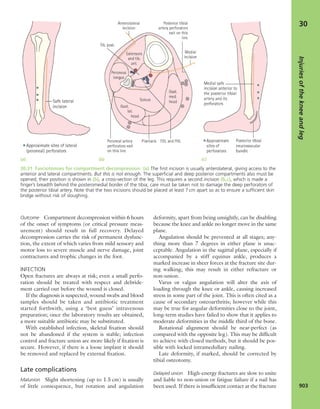 Apley's shoulderjt examination