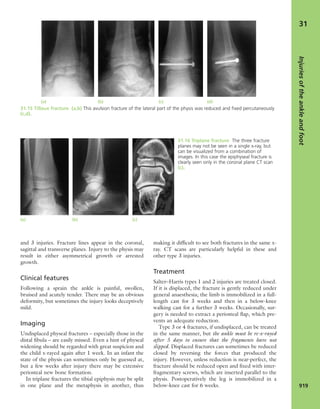 Apley's shoulderjt examination