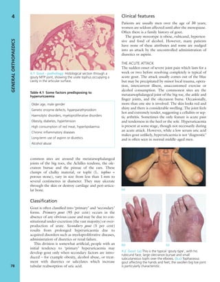 common sites are around the metatarsophalangeal
joints of the big toes, the Achilles tendons, the ole-
cranon bursae and the pinnae of the ears. These
clumps of chalky material, or tophi (L. tophus =
porous stone), vary in size from less than 1 mm to
several centimetres in diameter. They may ulcerate
through the skin or destroy cartilage and peri-articu-
lar bone.
Classification
Gout is often classiﬁed into ‘primary’ and ‘secondary’
forms. Primary gout (95 per cent) occurs in the
absence of any obvious cause and may be due to con-
stitutional under-excretion (the vast majority) or over-
production of urate. Secondary gout (5 per cent)
results from prolonged hyperuricaemia due to
acquired disorders such as myeloproliferative diseases,
administration of diuretics or renal failure.
This division is somewhat artiﬁcial; people with an
initial tendency to ‘primary’ hyperuricaemia may
develop gout only when secondary factors are intro-
duced – for example obesity, alcohol abuse, or treat-
ment with diuretics or salicylates which increase
tubular reabsorption of uric acid.
Clinical features
Patients are usually men over the age of 30 years;
women are seldom affected until after the menopause.
Often there is a family history of gout.
The gouty stereotype is obese, rubicund, hyperten-
sive and fond of alcohol. However, many patients
have none of these attributes and some are nudged
into an attack by the uncontrolled administration of
diuretics or aspirin.
THE ACUTE ATTACK
The sudden onset of severe joint pain which lasts for a
week or two before resolving completely is typical of
acute gout. The attack usually comes out of the blue
but may be precipitated by minor local trauma, opera-
tion, intercurrent illness, unaccustomed exercise or
alcohol consumption. The commonest sites are the
metatarsophalangeal joint of the big toe, the ankle and
ﬁnger joints, and the olecranon bursa. Occasionally,
more than one site is involved. The skin looks red and
shiny and there is considerable swelling. The joint feels
hot and extremely tender, suggesting a cellulitis or sep-
tic arthritis. Sometimes the only feature is acute pain
and tenderness in the heel or the sole. Hyperuricaemia
is present at some stage, though not necessarily during
an acute attack. However, while a low serum uric acid
makes gout unlikely, hyperuricaemia is not ‘diagnostic’
and is often seen in normal middle-aged men.
GENERALORTHOPAEDICS
78
4
4.1 Gout - pathology Histological section through a
gouty MTP joint, showing the urate tophus occupying a
cavity in the articular surface.
Table 4.1 Some factors predisposing to
hyperuricaemia
Older age, male gender
Genetic enzyme defects, hyperparathyroidism
Haemolytic disorders, myeloproliferative disorders
Obesity, diabetes, hypertension
High consumption of red meat, hyperlipidaemia
Chronic inﬂammatory diseases
Long-term use of aspirin or diuretics
Alcohol abuse
4.2 Gout (a) This is the typical ‘gouty type’, with his
rubicund face, large olecranon bursae and small
subcutaneous tophi over the elbows. (b,c) Tophaceous
gout affecting the hands and feet; the swollen big toe joint
is particularly characteristic.
(b) (c)
(a)
 