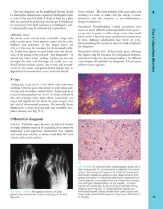 The true diagnosis can be established beyond doubt
by ﬁnding the characteristic negatively birefringent urate
crystals in the synovial ﬂuid. A drop of ﬂuid on a glass
slide is examined by polarizing microscopy. Crystals may
be sparse but if the ﬂuid specimen is centrifuged a con-
centrated pellet may be obtained for examination.
CHRONIC GOUT
Recurrent acute attacks may eventually merge into
polyarticular gout. Joint erosion causes chronic pain,
stiffness and deformity; if the ﬁnger joints are
affected, this may be mistaken for rheumatoid arthri-
tis. Tophi may appear around joints over the olecra-
non, in the pinna of the ear and – less frequently – in
almost any other tissue. A large tophus can ulcerate
through the skin and discharge its chalky material.
Renal lesions include calculi, due to uric acid precipi-
tation in the urine, and parenchymal disease due to
deposition of monosodium urate from the blood.
X-rays
During the acute attack x-rays show only soft-tissue
swelling. Chronic gout may result in joint space nar-
rowing and secondary osteoarthritis. Tophi appear as
characteristic punched-out ‘cysts’ or deep erosions in
the para-articular bone ends; these excavations are
larger and slightly further from the joint margin than
the typical rheumatoid erosions. Occasionally, bone
destruction is more marked and may resemble neo-
plastic disease (see Fig. 9.1).
Differential diagnosis
Infection Cellulitis, septic bursitis, an infected bunion
or septic arthritis must all be excluded, if necessary by
immediate joint aspiration. Remember that crystals
and sepsis may coexist, so always send ﬂuid for both
culture and crystal analysis.
Reiter’s disease This may present with acute pain and
swelling of a knee or ankle, but the history is more
protracted and the response to anti-inﬂammatory
drugs less dramatic.
Pseudogout Pyrophosphate crystal deposition may
cause an acute arthritis indistinguishable from gout –
except that it tends to affect large rather than small
joints and is somewhat more common in women than
in men. Articular calciﬁcation may show on x-ray.
Demonstrating the crystals in synovial ﬂuid establishes
the diagnosis.
Rheumatoid arthritis (RA) Polyarticular gout affecting
the ﬁngers may be mistaken for rheumatoid arthritis,
and elbow tophi for rheumatoid nodules. In difﬁcult
cases biopsy will establish the diagnosis. RA and gout
seldom occur together.
Crystaldepositiondisorders
79
4
4.3 Gout – x-rays The typical picture is of large
periarticular excavations – tophi consisting of uric acid
deposits.
4.4 Crystals In polarized light, crystals appear bright on a
dark background. If a compensator is added to the optical
system, the background appears in shades of mauve and
birefringent crystals as yellow or blue, depending on their
spatial orientation. In these two specimens (obtained from
crystal deposits in cartilage) there are differences in shape,
size and type of birefringence of the crystals. (a) Urate
crystals are needle-like, 5–20 μm long and exhibit strong
negative birefringence. (b) Pyrophosphate crystals are
rhomboid-shaped, slightly smaller than urate crystals and
show weak positive birefringence. (Courtesy of Professor P.
A. Dieppe).
(b)
(a)
 