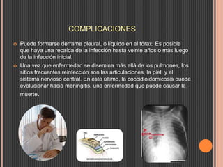 COMPLICACIONES
 Puede formarse derrame pleural, o líquido en el tórax. Es posible
que haya una recaída de la infección hasta veinte años o más luego
de la infección inicial.
 Una vez que enfermedad se disemina más allá de los pulmones, los
sitios frecuentes reinfección son las articulaciones, la piel, y el
sistema nervioso central. En este último, la coccidioidomicosis puede
evolucionar hacia meningitis, una enfermedad que puede causar la
muerte.
 
