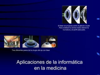 El láser se proyecta sobre el glóbulo ocular
                                                         Para moldear la córnea hasta obtener la
                                                               Curvatura y el perfil adecuado.




Tres diferentes pasos de la cirugía del ojo con láser




      Aplicaciones de la informática
              en la medicina
 