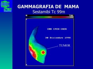 GAMMAGRAFIA DE  MAMA   Sestamibi Tc 99m TUMOR 
