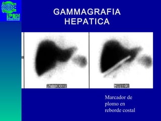 GAMMAGRAFIA HEPATICA Marcador de plomo en reborde costal 
