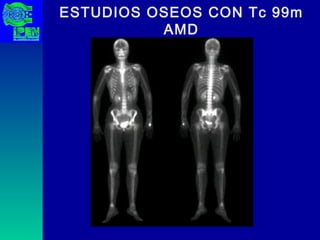 ESTUDIOS OSEOS CON Tc 99m AMD 