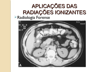 APLICAÇÕES DAS
RADIAÇÕES IONIZANTES

 Radiologia

Forense

 