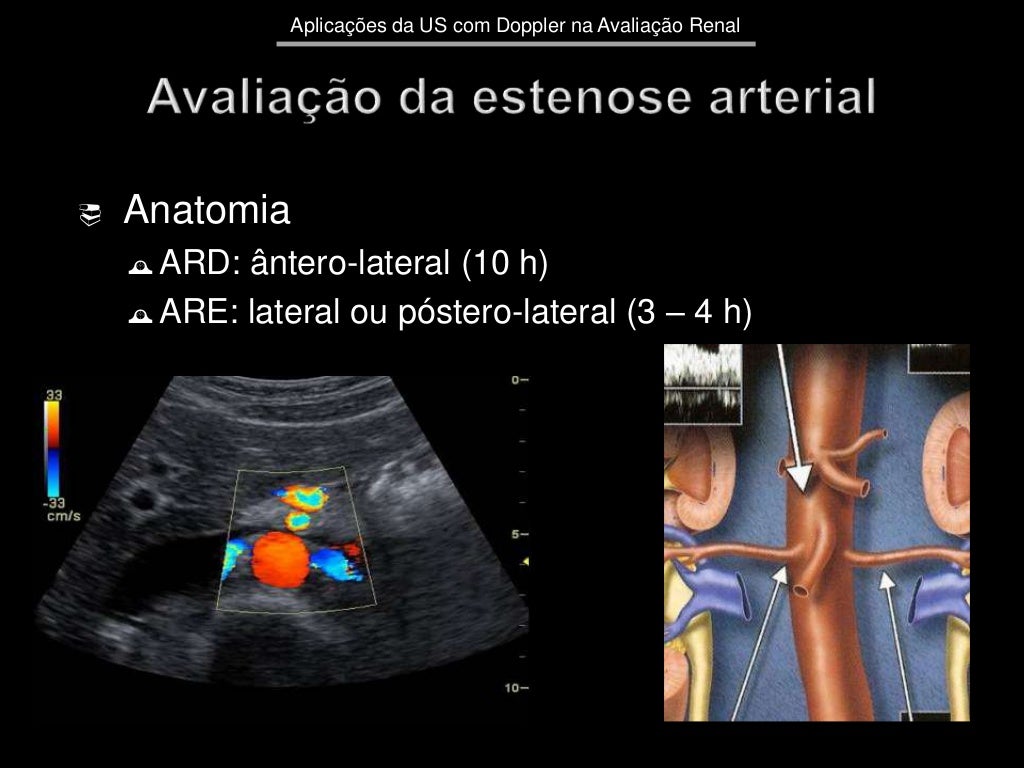 Como é Feito O Exame Doppler De Artérias Renais Aplicações da ultrassonografia com Doppler na avaliação renal
