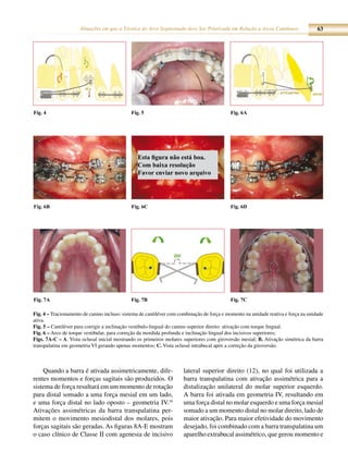 Situações em que a Técnica do Arco Segmentado deve Ser Priorizada em Relação a Arcos Contínuos                 63




Fig. 4                                       Fig. 5                                        Fig. 6A




                                                Esta figura não está boa.
                                                Com baixa resolução
                                                Favor enviar novo arquivo




Fig. 6B                                      Fig. 6C                                       Fig. 6D




Fig. 7A                                      Fig. 7B                                       Fig. 7C

Fig. 4 – Tracionamento de canino incluso: sistema de cantiléver com combinação de força e momento na unidade reativa e força na unidade
ativa.
Fig. 5 – Cantiléver para corrigir a inclinação vestibulo-lingual do canino superior direito: ativação com torque lingual.
Fig. 6 – Arco de torque vestibular, para correção da mordida profunda e inclinação lingual dos incisivos superiores;
Figs. 7A-C – A. Vista oclusal inicial mostrando os primeiros molares superiores com giroversão mesial; B. Ativação simétrica da barra
transpalatina em geometria VI gerando apenas momentos; C. Vista oclusal intrabucal após a correção da giroversão.



    Quando a barra é ativada assimetricamente, dife-                  lateral superior direito (12), no qual foi utilizada a
rentes momentos e forças sagitais são produzidos. O                   barra transpalatina com ativação assimétrica para a
sistema de força resultará em um momento de rotação                   distalização unilateral do molar superior esquerdo.
para distal somado a uma força mesial em um lado,                     A barra foi ativada em geometria IV, resultando em
e uma força distal no lado oposto – geometria IV.16                   uma força distal no molar esquerdo e uma força mesial
Ativações assimétricas da barra transpalatina per-                    somado a um momento distal no molar direito, lado de
mitem o movimento mesiodistal dos molares, pois                       maior ativação. Para maior efetividade do movimento
forças sagitais são geradas. As figuras 8A-E mostram                  desejado, foi combinado com a barra transpalatina um
o caso clínico de Classe II com agenesia de incisivo                  aparelho extrabucal assimétrico, que gerou momento e
 
