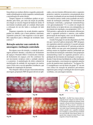 64        Ortodontia e Ortopedia Funcional dos Maxilares


força distais nos molares direito e esquerdo, potenciali-   cadas, com movimentos diferenciais entre o segmento
zando a distalização no molar esquerdo e neutralizando      posterior e anterior; no posterior, esta proporção deve
a mesialização do molar direito.                            ser maior, resultando em um movimento de translação
    Torques linguais ou vestibulares podem ser pro-         e no anterior menor, tendo como resultado um movi-
duzidos pela barra, por meio da torção da presilha          mento de inclinação controlada.33 No movimento de
em relação ao encaixe lingual da banda do molar. O          inclinação controlada, a proporção momento/força
movimento resultante pode ser avaliado observando           é de aproximadamente 7:1 e o centro de rotação do
a colocação de um dos lados e avaliação do lado             dente localiza-se no ápice da raiz; em contrapartida, no
oposto.                                                     movimento de translação, essa proporção é 10:1.33 A
    Pequenas expansões da arcada dentária superior          TAS permite a aplicação de movimentos diferenciais
podem ser obtidas com a barra palatina; entretanto,         entre o segmento posterior e anterior, com melhor
expansões acima de 2 mm requerem o uso de apare-            preservação da ancoragem, sem o uso de dispositivos
lhos específicos para a obtenção de resultados mais         acessórios, como o aparelho extrabucal.
estáveis.32                                                     A mola T do grupo A é um dos dispositivos da TAS
                                                            em que é possível aplicar proporções M/F desiguais
Retração anterior com controle de                           nos segmentos anterior e posterior. A sua pré-ativação
                                                            é realizada por uma dobra de 45° próxima ao tubo do
ancoragem e inclinação controlada
                                                            molar, dobra essa que gera uma proporção momen-
    Em alguns casos de extração, o controle da anco-        to/força menor no segmento anterior, produzindo um
ragem posterior durante a mecânica de fechamento            movimento de inclinação controlada e uma proporção
de espaços é bastante difícil. A maioria dos sistemas       momento/força maior no segmento posterior com a
de fechamento de espaços com fios contínuos faz             produção de movimentos de translação e correção ra-
um movimento recíproco entre a unidade anterior             dicular. Como há mais facilidade de se obter inclinação
e a posterior. A neutralização do efeito colateral de       do que translação, o movimento no segmento anterior
mesialização da unidade de ancoragem em muitos              ocorre de maneira mais significativa.33 As figuras 9A-
casos é feita com o uso de aparelhos extrabucais, que       C exemplificam o uso da mola t do grupo “A” em um
depende da cooperação do paciente.                          caso clínico de extração de primeiros pré-molares
    Nas situações clínicas em que é necessária máxima       superiores para corrigir a inclinação dos incisivos para
ancoragem, proporções M/F desiguais devem ser apli-         vestibular, com ancoragem máxima.




                                                                                                  Extrabucal




Fig. 8A                                  Fig. 8B                              Fig. 8C

                                                                               Fig. 8A-E – A e B. Vistas laterais direita e
                                                                               esquerda inicial: relação de molar Classe II;
                                                                               C. Distalização unilateral do primeiro molar
                                                                               esquerdo: ativação da barra transpalatina em
                                                                               geometria IV, força mesial e momento no
                                                                               molar direito e força distal no molar esquerdo
                                                                               (em verde), forças e momentos distais nos dois
                                                                               molares gerados com o aparelho extrabucal
                                                                               (em vermelho) e o sistema de forças resultante
                                                                               (em azul); D e E. Vistas laterais direita e es-
                                                                               querda final: relação de molar Classe I, lado
Fig. 8D                                  Fig. 8E                               esquerdo e Classe II, lado direito.
 