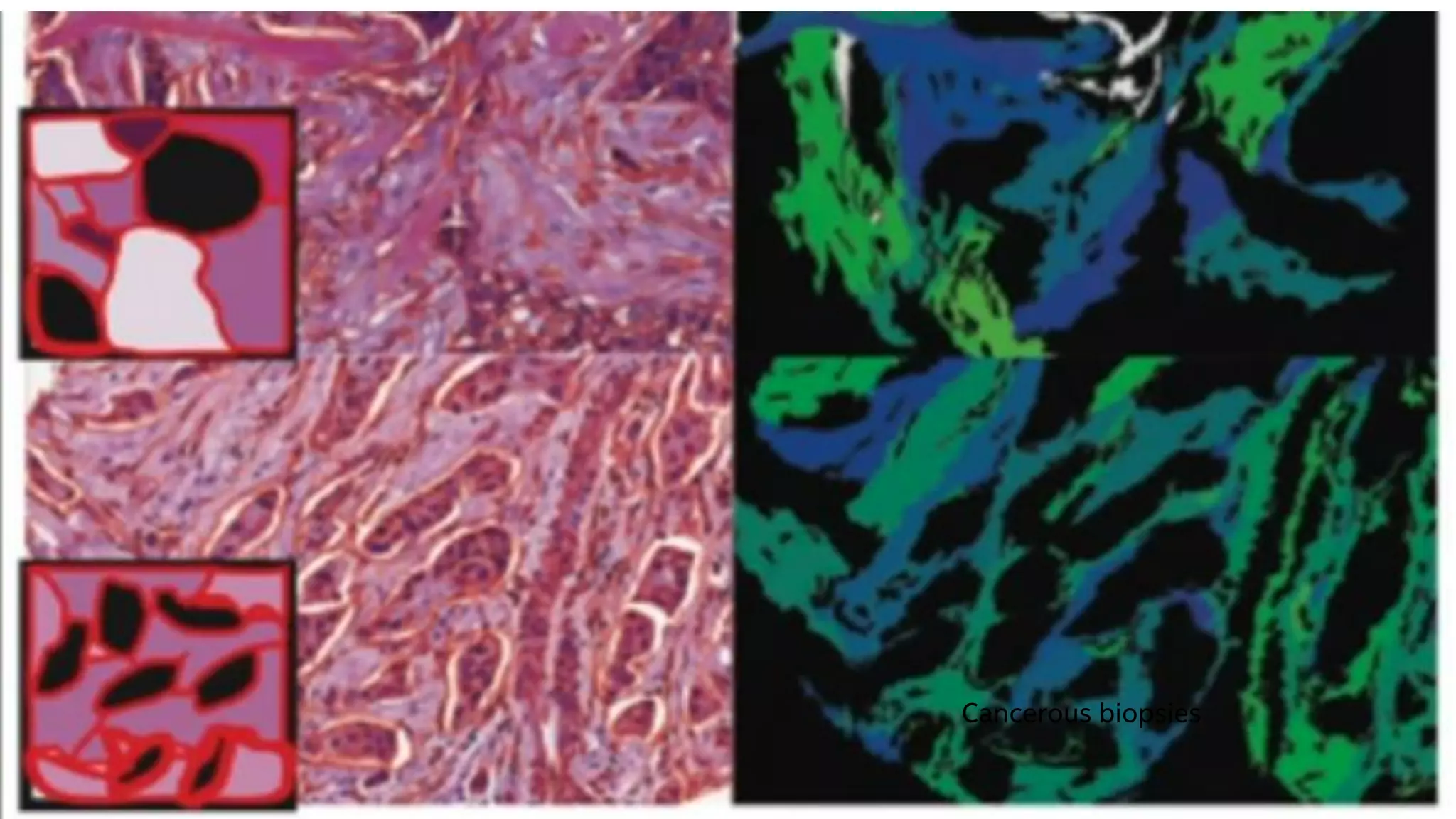 Software Services Group – Developer Relations Division
Cancerous biopsies
 