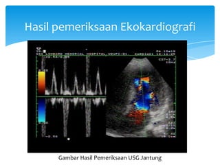 Hasil pemeriksaan Ekokardiografi
Gambar Hasil Pemeriksaan USG Jantung
 