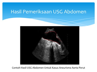 Hasil Pemeriksaan USG Abdomen
Contoh Hasil USG Abdomen Untuk Kasus Aneurisma Aorta Perut
 