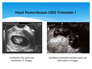 Hasil Pemeriksaan USG Trimester I
Gambaran USG pada usia
kehamilan 8 minggu
Gambaran kehamilan kembar pada usia
kehamilan 10 minggu
Ultrasonografi Obstetrik
 