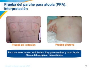 12Información confidencial y reservada de MJN
Prueba del parche para atopia (PPA): 
interpretación
Prueba de irritación  Prueba positiva
Pero las fotos no son suficientes: hay que examinar y tocar la piel.
Claves del alérgeno / mecanismos
 
