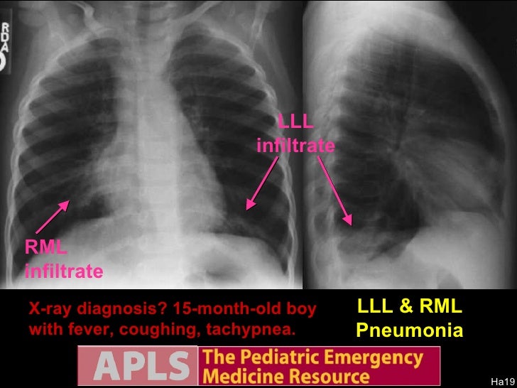 Apls Pediatric Emergency Radiology 1