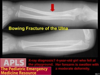 X-ray diagnosis? 4-year-old girl who fell at the playground.  Bowing Fracture of the Ulna Her forearm is swollen with a moderate deformity.  