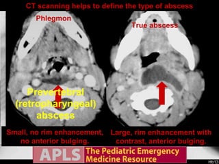 X-ray diagnosis? 7 year old male with fever, sore throat, headache and neck stiffness, sent to the ED for possible meningitis.  Prevertebral (retropharyngeal)abscess An LP is done: normal.  Lateral neck x-ray demonstrates bulging of the prevertebral soft tissue, suspected abscess. False positives sometimes occur: Prevertebral soft tissue appears wide. Neck extension results in a normal prevertebral soft tissue appearance. Position the neck properly to avoid false positives Prevertebral soft tissue appears wide. Neck extension demonstrates persistence of the prevertebral soft tissue widening. The Step-Off sign is sometimes helpful The back of the pharynx should NOT be in line with the trachea. Note that the back of the pharynx is in line with the trachea. Normal Step-Off Abnormal: Step-Off is absent CT scanning helps to define the type of abscess Large, rim enhancement with contrast, anterior bulging. Small, no rim enhancement, no anterior bulging. True abscess Phlegmon 