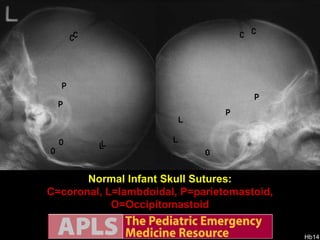 Normal Infant Skull Sutures: S=Sagittal, C=Coronal, L=lambdoidal Normal Infant Skull Sutures: C=coronal, L=lambdoidal, P=parietomastoid, O=Occipitomastoid 