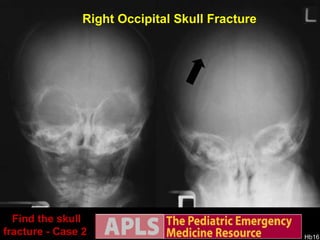Find the skull fracture - Case 2  Right Occipital Skull Fracture 