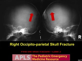 Find the skull fracture - Case 3 AP views Right Occipito-parietal Skull Fracture Lateral views 