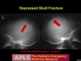 Find the skull fracture - Case 4 AP views Depressed Skull Fracture Lateral views 