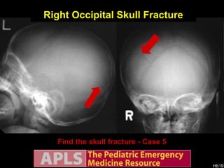 Find the skull fracture - Case 5 Right Occipital Skull Fracture 