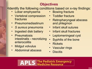 Objectives Identify the following conditions based on x-ray findings: Lobar emphysema Vertebral compression fractures Pneumomediastinum S aureus  pneumonia Ingested disk battery Pneumatosis intestinalis - necrotizing enterocolitis Midgut volvulus Abdominal abscess Bowing fracture Toddler fracture Retropharyngeal abscess and phlegmon Infant skull sutures Infant skull fractures Leptomeningeal cyst Syphilis of the bone Rickets Vascular rings Discitis 