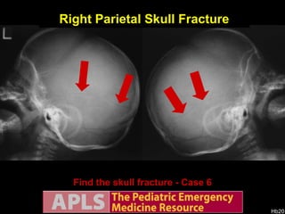 AP views Find the skull fracture - Case 6 Right Parietal Skull Fracture Lateral views 