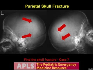 AP views Find the skull fracture - Case 7 Parietal Skull Fracture Lateral views 