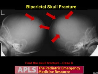 AP views Find the skull fracture - Case 8 Biparietal Skull Fracture Lateral views 